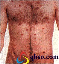 佛法救了一個TXL的艾滋病患者